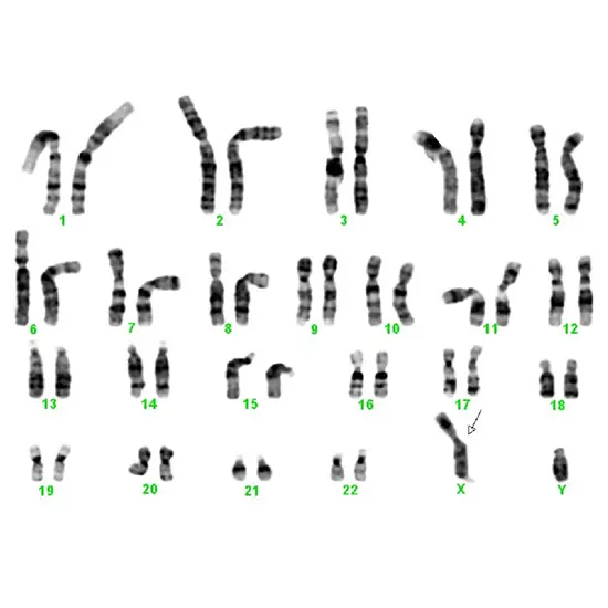 Chromosome Analysis, Fragile X